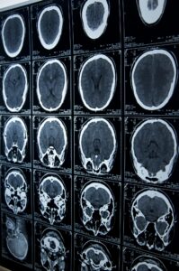 Types of Memphis, TN Traumatic Brain Injury Lawyer Cases We Handle
